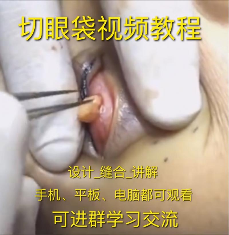 切眼袋手术视频内吸眼袋外切眼袋视频教程